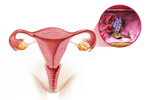 巧克力囊肿治疗方法